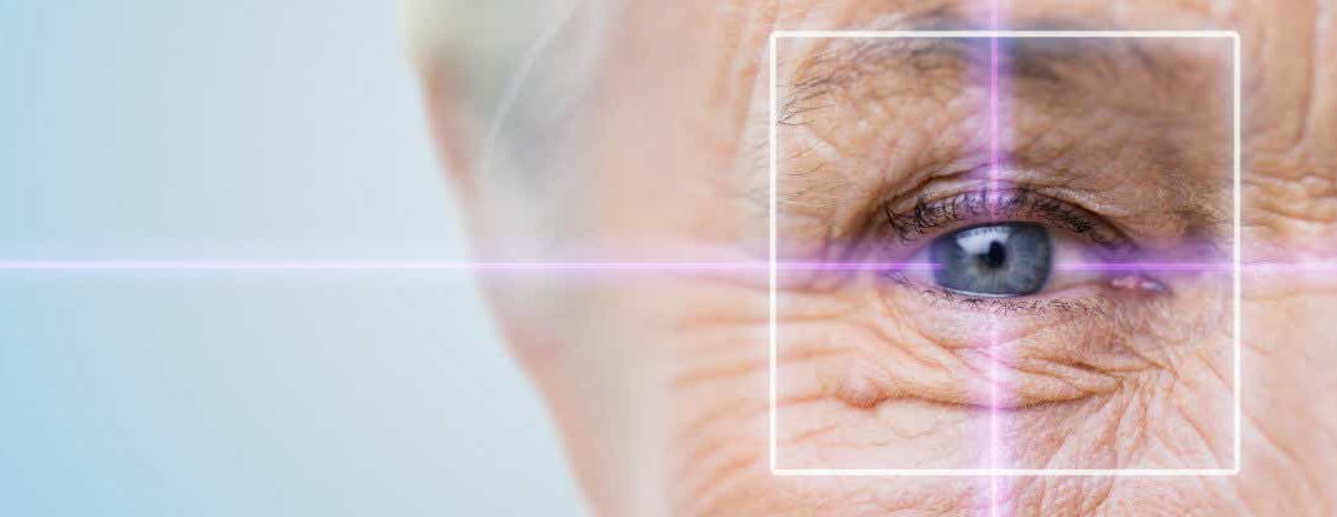 Лазерная факоэмульсификация катаракты